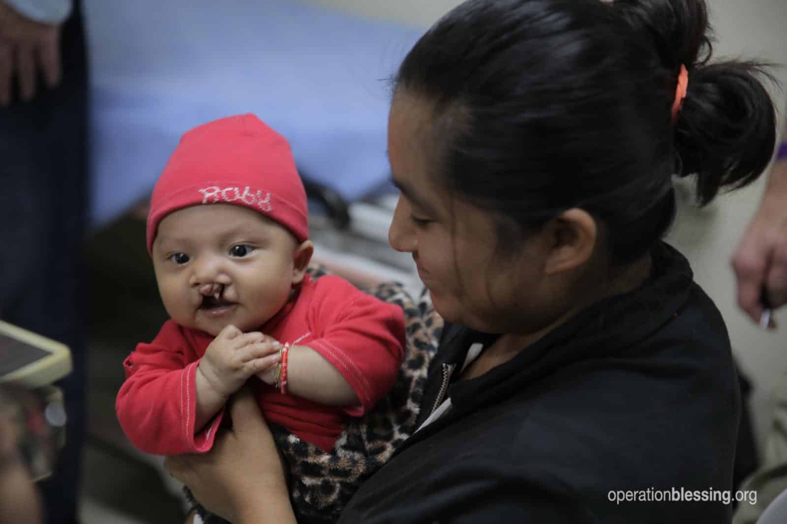 Wilson received a life-changing surgery for his cleft lip.